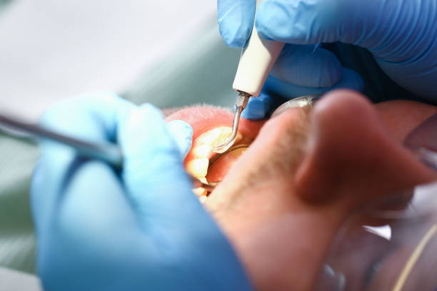 Best Lost Filling or Crown Replacement in Nashvle, IL